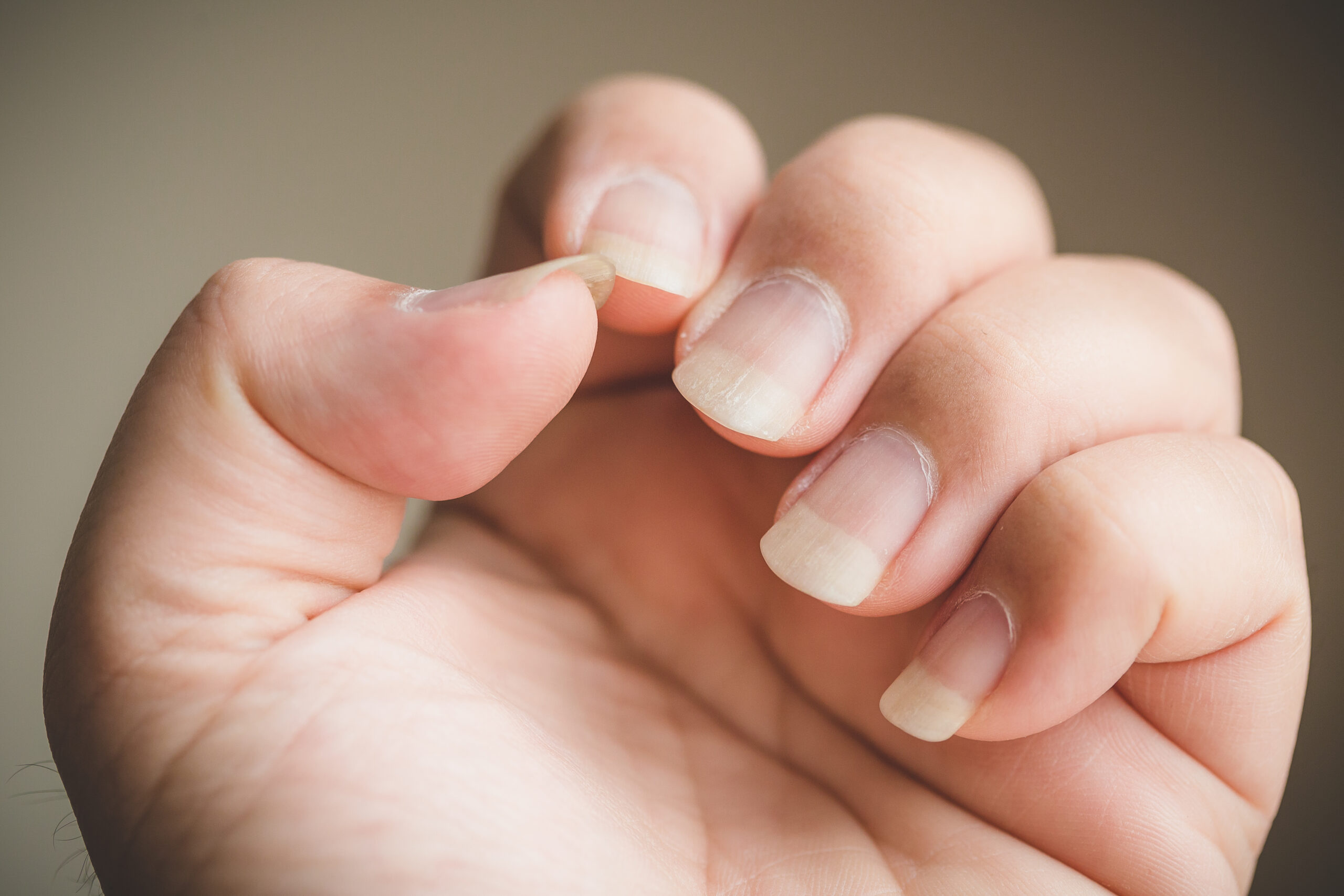 Nail Abnormalities